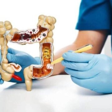 Um grupo de médicos discute os sintomas de alerta do câncer de intestino para conscientizar a população sobre a importância da prevenção e detecção precoce.