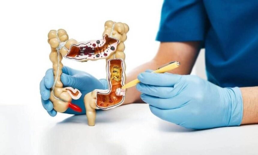 Um grupo de médicos discute os sintomas de alerta do câncer de intestino para conscientizar a população sobre a importância da prevenção e detecção precoce.